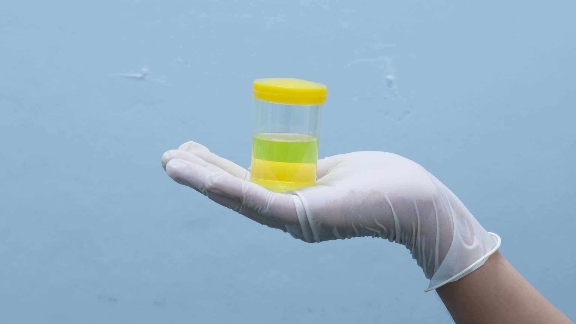 Hematíes en la Orina Qué Es la Hematuria